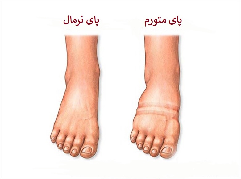 ورم پای چپ