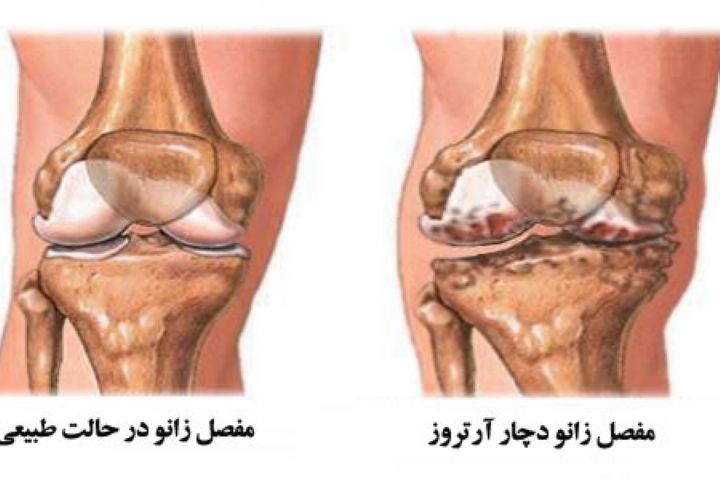 علت تعویض مفصل زانو