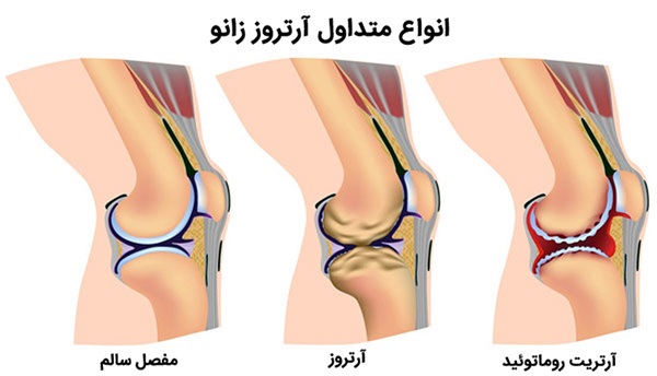 آرتروز و مشکلات
مفصلی