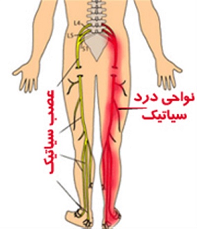 رگ سیاتیک چیست؟