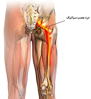 رگ سیاتیک چیست؟